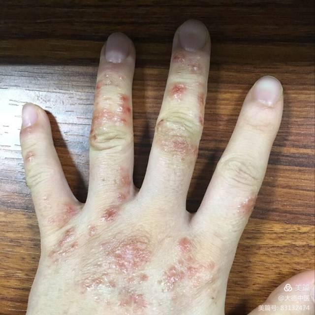 湿疹预防方法有哪些【惠州广肤皮肤病医院治疗湿疹好不好】