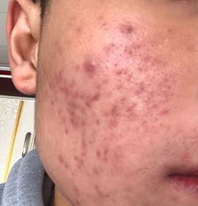 如何正确护理痤疮患者的日常生活【惠城广肤皮肤病专科医院】